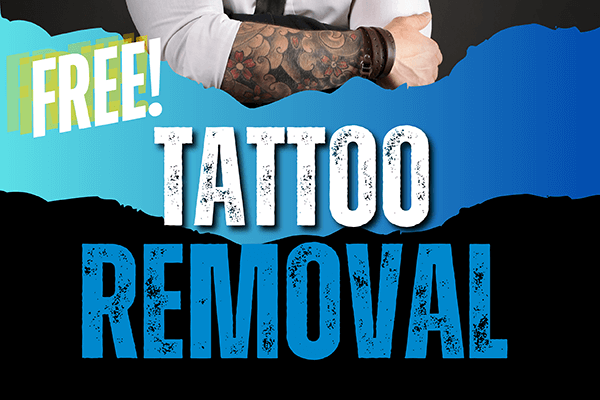 Tatoo Removal